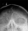 An x-ray of frontal bone sinuses