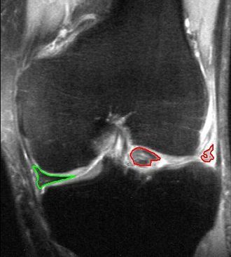 Bucket-handle tear of the lateral meniscus (red). Medial meniscus intact (green). MRI, coronal T2 *-weighted GRE sequence. MBq korbhenkelriss.jpg