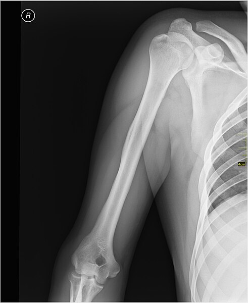 File:Medical X-Ray imaging MYD06 nevit.jpg