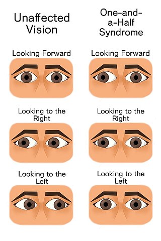 <span class="mw-page-title-main">One and a half syndrome</span> Medical condition