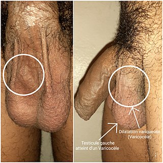 <span class="mw-page-title-main">Varicocele</span> Abnormal enlargement of the pampiniform plexus veins in the genitals