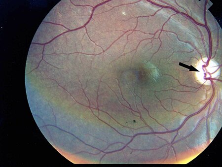 صورة لعين يمنى لمريض يعناي من ضمور بصري من دون اعتلال الشبكية السكري[1]