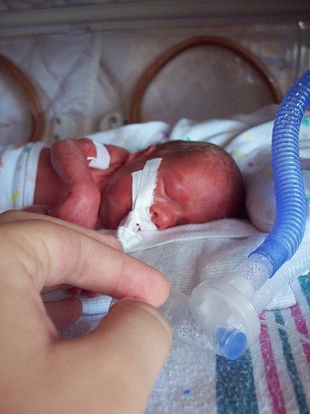 A Premature Baby in a ventilator