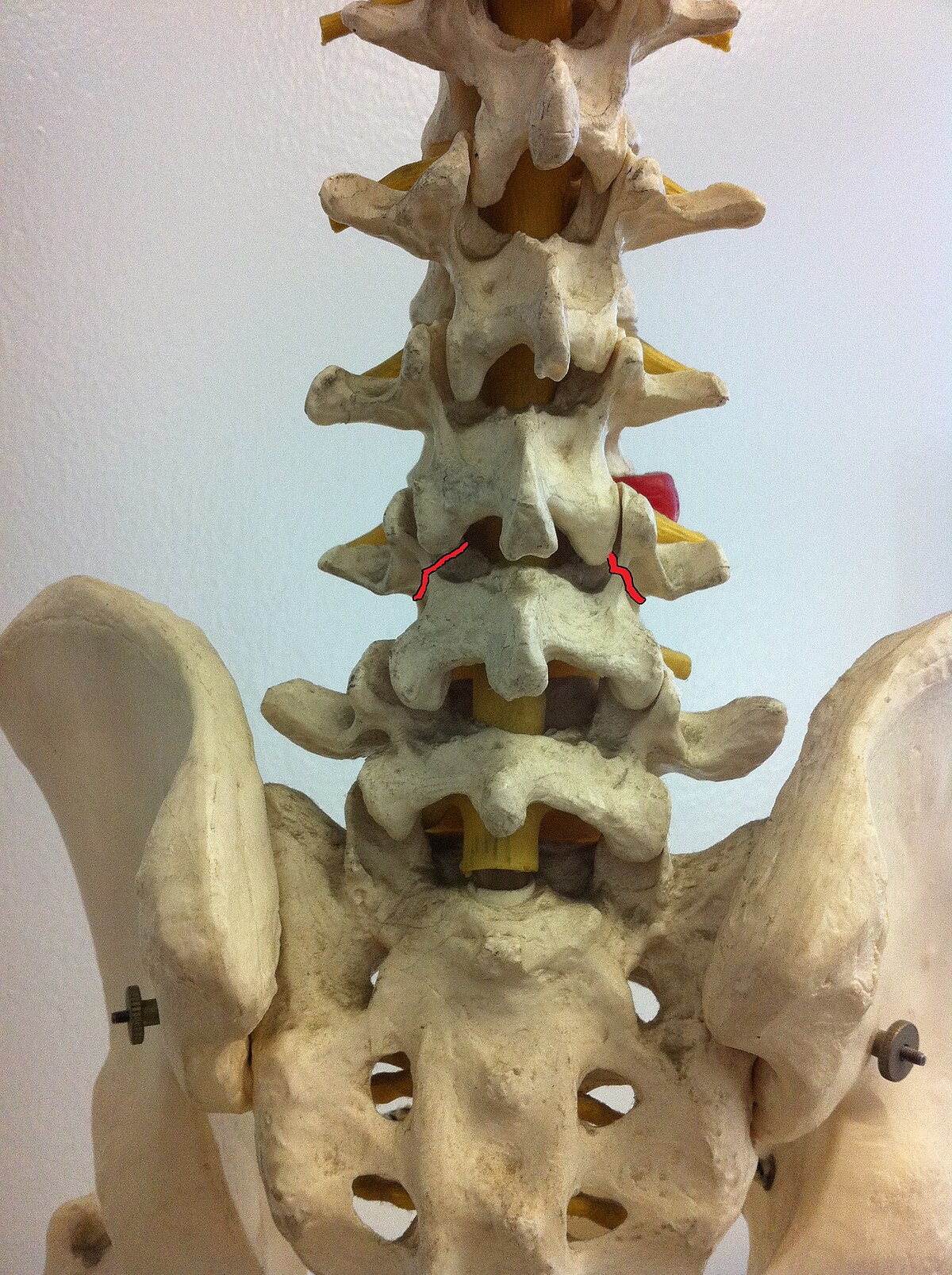 https://upload.wikimedia.org/wikipedia/commons/thumb/3/3e/Spondylolysis-_back_pain.jpg/1200px-Spondylolysis-_back_pain.jpg