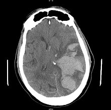 Subfalcine herniation on CT Subfalcine-herniation-001.jpg