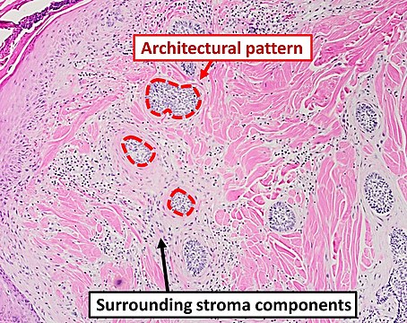 Architectural pattern of any suspicious cells, in this case nests of cells, as well as components of the intervening stroma.