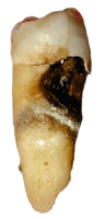 Hammasytimeen eli pulpaan edennyt karies. Vaurioita enimmäkseen hammasjuuren alueella.
