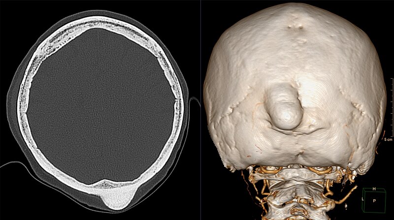 File:Typisches solides Osteom der Schaedelkalotte 75W - CT axial und VR - 001.jpg