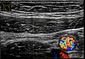 Axial plane, with Doppler signal from the iliac vessels.