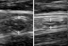 A normal appendix without and with compression. Absence of compressibility indicates appendicitis.[101]