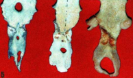 Tres especímenes de apófisis xifoides dotadas de foramen.