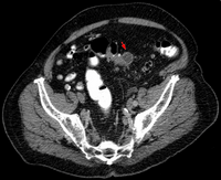 Obraz CT Mały ropień w jamie brzusznej spowodowany stanem zapalnym uchyłków