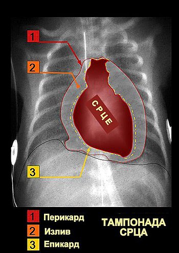 Tamponada srca izazvana izlivom tečnosti u perikardnoj šupljini