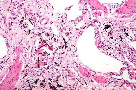 Micrograph of asbestosis showing the characteristic ferruginous bodies and marked interstitial fibrosis (or scarring). H&E stain.