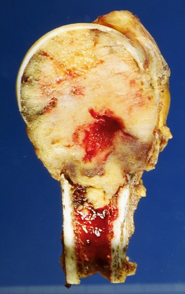 File:Bone metastasis.jpg