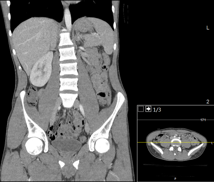 CT of a normal abdomen and pelvis, coronal plane 72.png