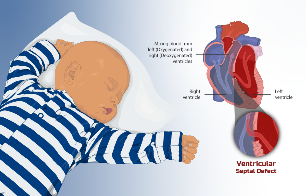 Depiction of a child with Congenital Heart Disease.png