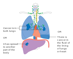 Diagram showing stage 4 lung cancer CRUK 232.svg