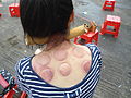 Ventosaterapia nas ruas de Haikou, China
