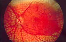 Fundus photo showing scatter laser surgery for diabetic retinopathy EDA09.JPG