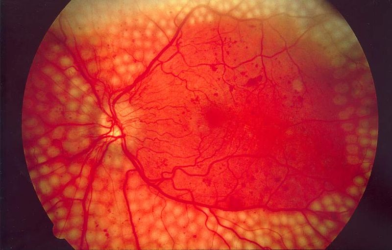 retinopatia diabetica no proliferativa sintomas cukor szint étkezés után