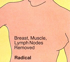 Mastectomy (radical).jpg