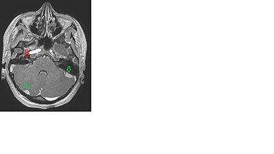 Neurofibromatose de type II