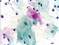 An obviously atypical cell can be seen