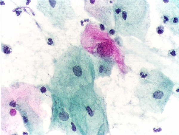 Cytopathology: microscopic appearance of a Pap test. The pink cell at the center with a large nucleus is abnormal, compatible with low-grade dysplasia