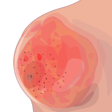 Inlfamatory breast cancer with peau d'orange Peau d orange inflamatory breast cancer svg hariadhi.svg