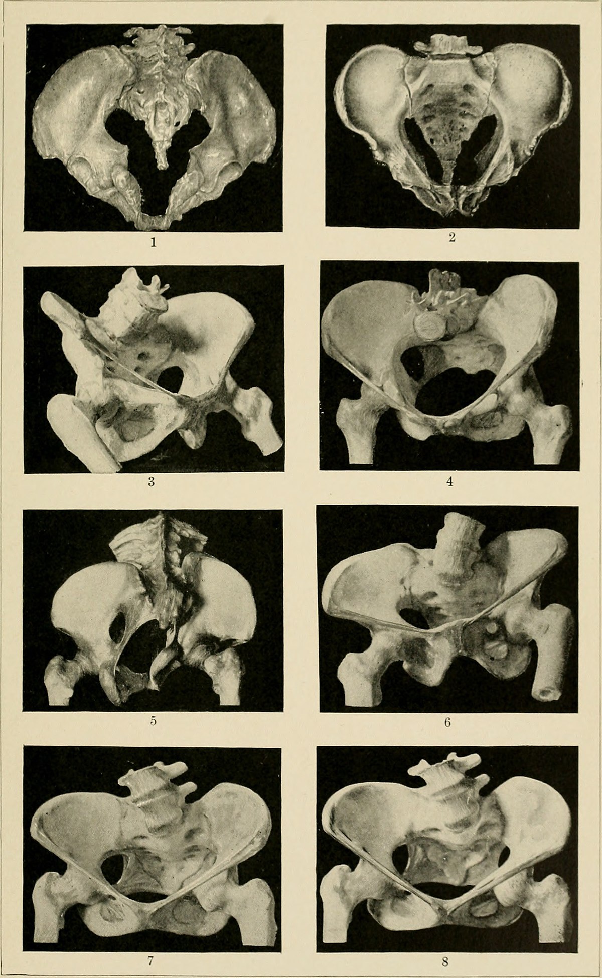 varicoza de pelvis mici i sarcina