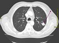 TC del distretto toracico che mostra una massa neoplastica nel polmone sinistro.
