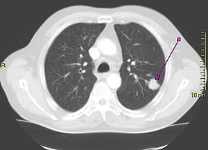 Cancer Du Poumon: Historique, Épidémiologie, Étiologie