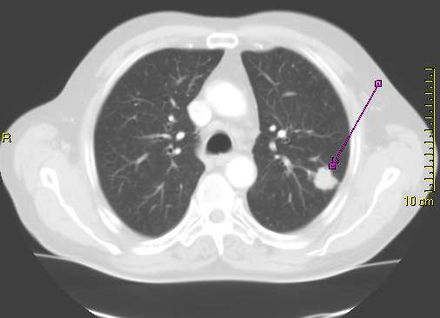 CT scan showing a cancerous tumour in the left lung