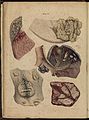Tuberculous lungs. Robert Carswell 1830s Wellcome L0074383.jpg