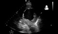 File:UOTW 48 - Ultrasound of the Week 2.webm
