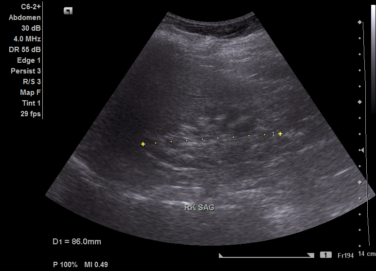 File:Ultrasound showing right kidney medullary nephrocalcinosis.tif