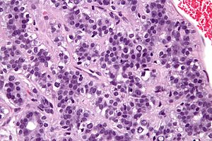 Adenomyoepithelioma - very high mag.jpg