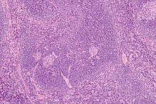 Intermediate magnification micrograph of Castleman disease showing the characteristic expansion of the mantle zone. H&E stain Castleman disease - intermed mag.jpg