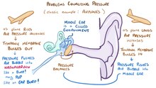 ملف:Eustachian Tube Disfunction.webm