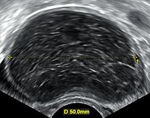 Ultrasonography Hemorrhagic Ovarian Cyst Hemorrhagic ovarian cyst.jpg