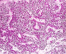 Histology of a null cell adenoma Histopathology of a true null cell adenoma.jpg