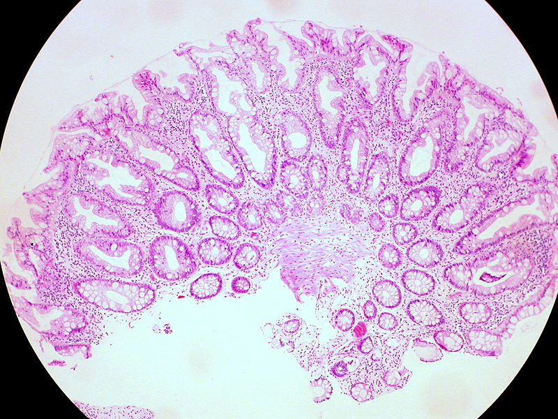 File:Hyperplastic Polyp of the Rectum (14060044206).jpg