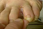 Miniatuur voor Ringworm (schimmel)