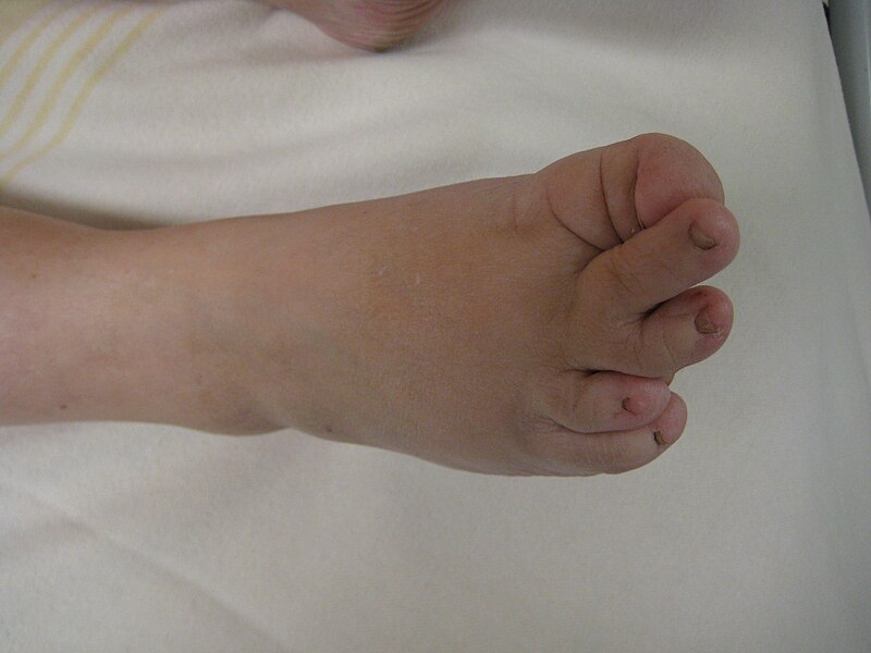 القدم اليمنى من شخص مع لانجر–Giedion متلازمة تظهر ملامح مميزة