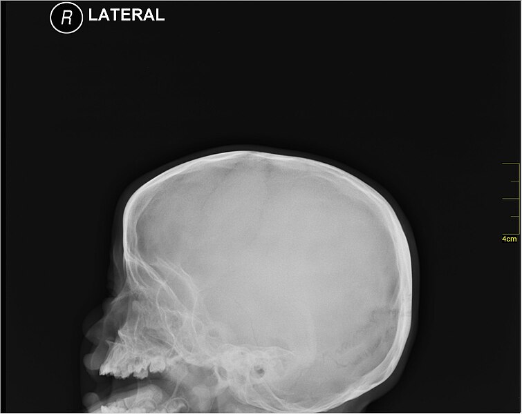 File:Medical X-Ray imaging GXF04 nevit.jpg