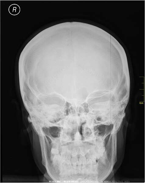 File:Medical X-Ray imaging SFA07 nevit.jpg