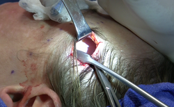Mid facelift (rhytidectomy) upper incision.png