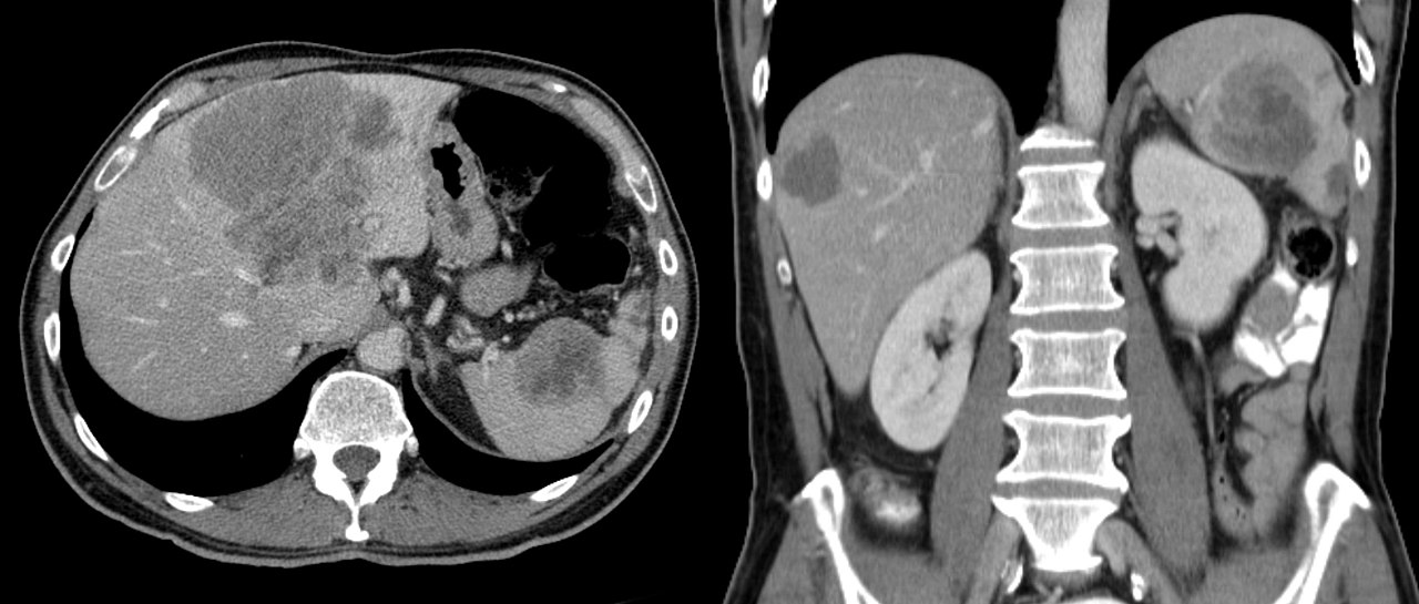 Coronary Atherosclerosis