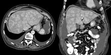 CT appearance of liver in congestive hepatopathy, sometimes referred to as a nutmeg liver. Due to congestion, contrast does not flow through the liver in a normal manner. Axial and coronal images in the portal venous phase. Muskatnussleber - 69jw - CT axial und coronar pv - 001.jpg